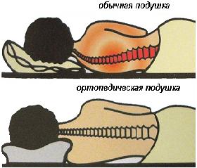 правильное положение на ортопедической подушке. 